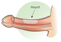 allograft