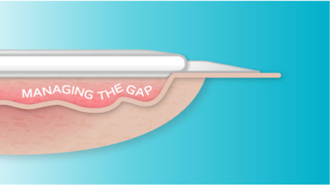 How do you manage the gap between the wound bed and dressing?