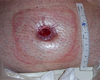 Stoma retraction