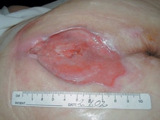The ulcer after four weeks of treatment.