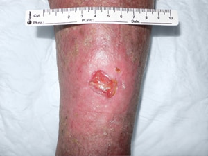 leg ulcer