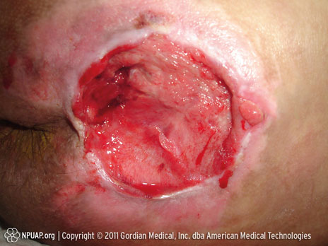 Pressure ulcer Category/Stage IV: Full thickness tissue loss (muscle/bone visible)