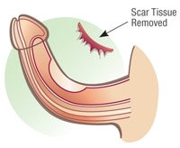 penis scar tissue removal