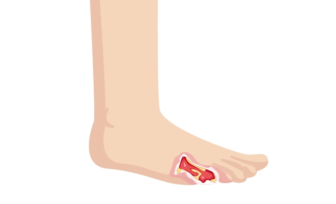 Diabetic foot