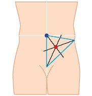 Stoma marking