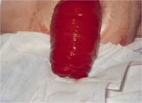 Stoma prolapse